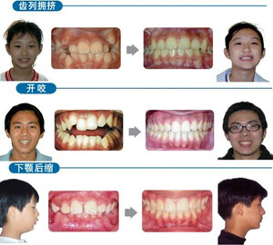 儿童牙齿矫正有没有副作用? 儿童牙齿矫正有没有副作用?