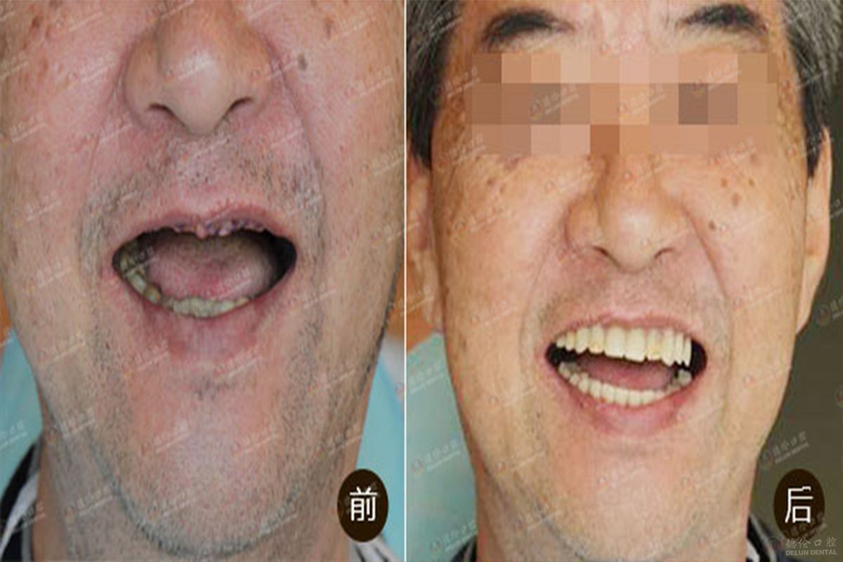 又一位高龄无牙老人种全口"真"牙