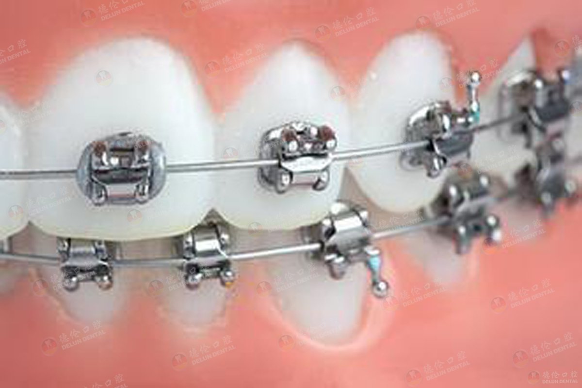 牙齿矫正——自锁托槽矫正流程 - 知乎
