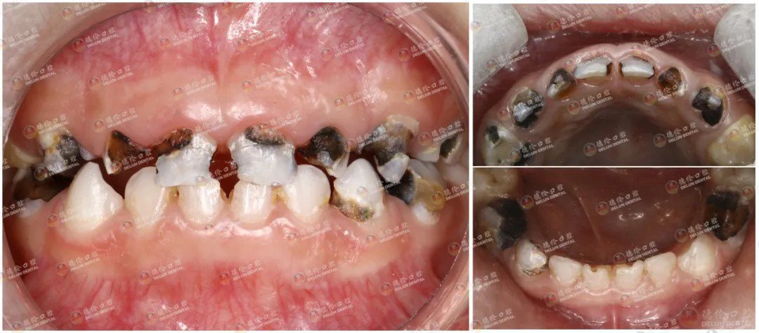 德伦口腔儿童牙科刘阗主任发现,小患者多颗牙齿已达重度龋坏,若不及时